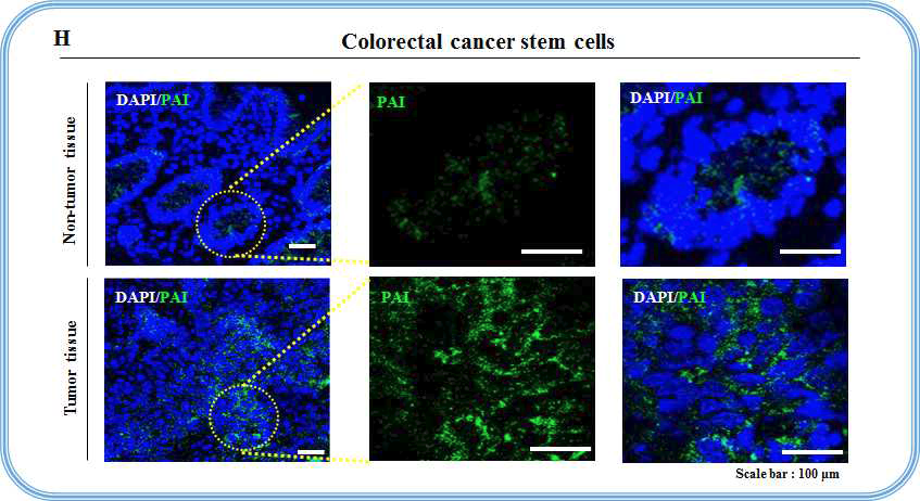 대장암 조직에서 PAI의 발현과 발암성의 상관 관계 검증