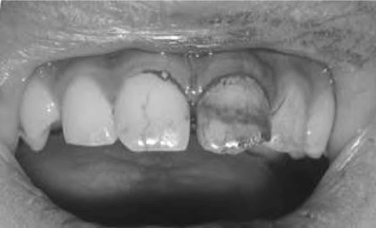 좌측 중절치의 탈구 및 치관파절 치아