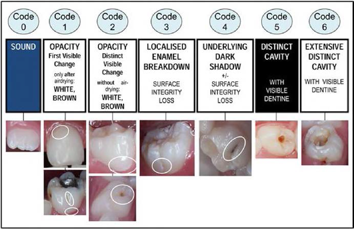 ICDAS detection criteria and samples of caries lesions