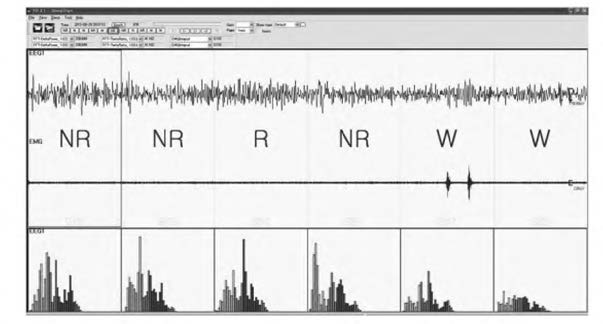 Sleep Sign 프로그램을 이용한 수면 구조 분석 사례