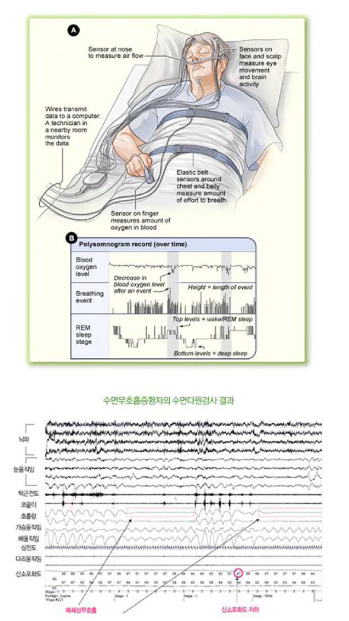수면다원검사 및 수면다원검사 결과