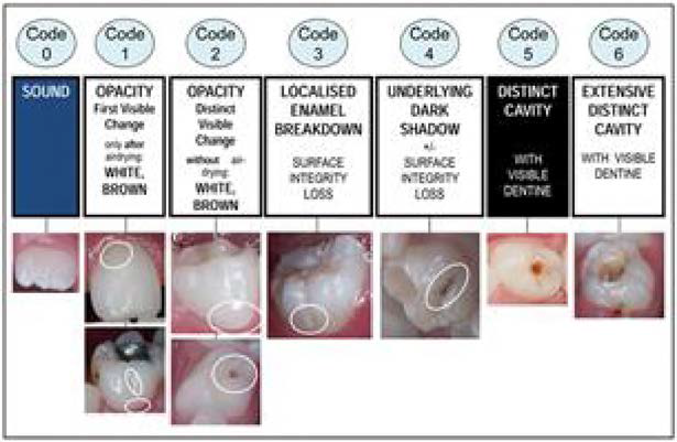 ICDAS detection criteria and samples of caries lesions