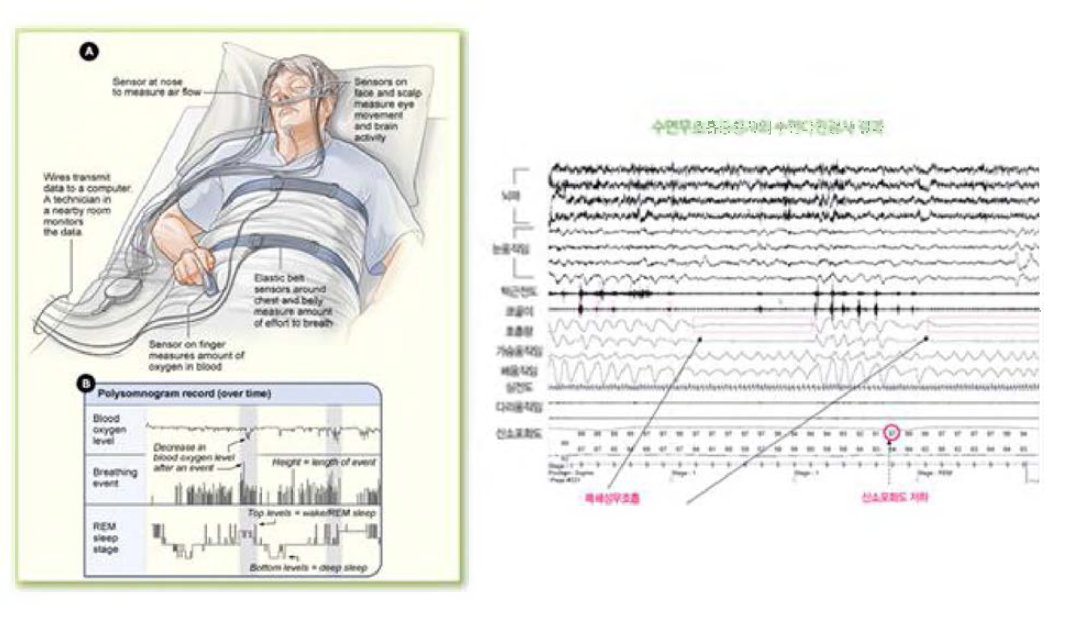 수면다원검사 및 수면다원검사 결과