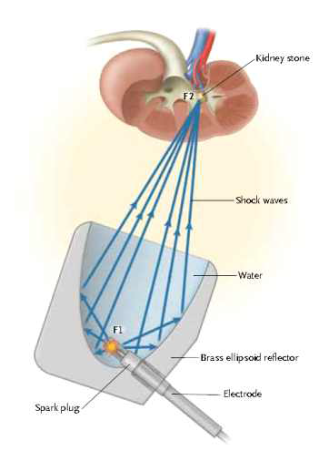 Electrohydraulic Lithotripter