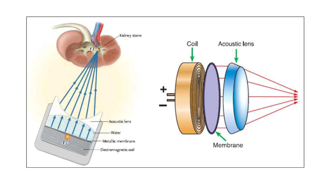 Electromagnetic Lithotripter(membrane 방식)