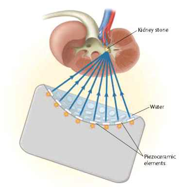 Piezoelectric Lithotripter