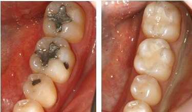 치아 우식 치료를 위한 아말감 수복(좌)과 복합레진 수복(우)