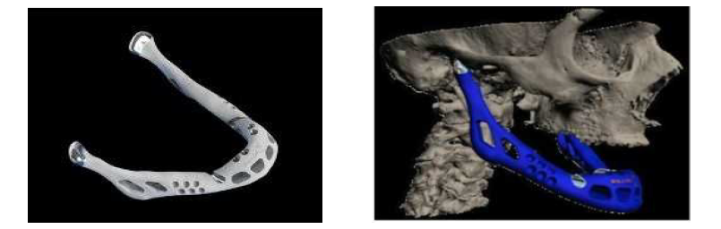 벨기에의 레이어와이즈 (Layer Wise) 사에 의해 개발된 하악골 모형(좌)과 실제 환자에게 적용 후 사진(우)