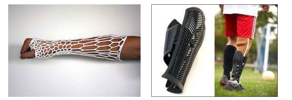 3D 프린팅 기술로 제작된 환자 맞춤형 Splint.