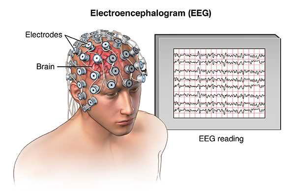 EEG 뇌 간질 측정장비.