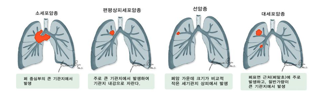 폐암의 종류