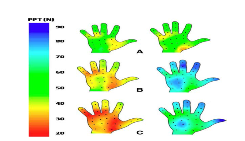 Pressure pain sensitivity 분석 결과