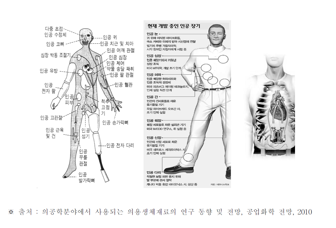 의용생체재료가 인체에 사용되는 예