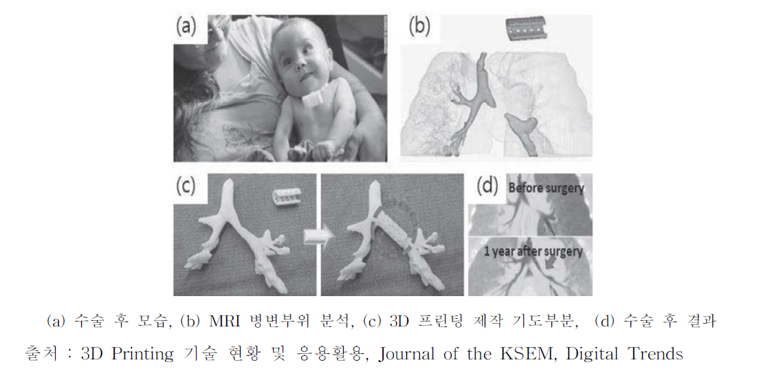 - 89 - 연도 업체명 요약 설명 2015 중앙대학교병원 3D 프린팅 기술을 이용 한 두개골성형재료의 임 상적용 안전성에 관한 연구자 임상시험 3D 프린팅으로 제작한 순수 고강도 티타 늄 두개골을 뇌출혈로 뇌가 비정상적으로 부풀어 올랐다가 두개골 아래로 심하게 함 몰된 환자에게 이식하였다. 이 임상은 신 속하면서 환자 개인에 맞는 매우 정밀한 형상으로 제작되었고 두개골 이식수술을 성공적으로 실시되었다. 국내 임상 현황은 2015년 1건으로 조사되었으며 두개골 임플란트의 안전성에 관한 내용 이다. 표. 국내 3D 프린팅 임상 현황 ※ 출처 : 연도별 의료기기 임상시험계획 승인 현황, 식품의약품안전처, 2016 ② 국내·외 임상 활용 사례 미국 미시간 대학 병원의 의료진과 공대 연구진은 3D Printer를 활용하여 ‘기관지연골연화증’ 을 겪는 아이의 기도 형상을 MRI로 촬영해 분석한 뒤, 3D 프린팅 기술로 맞춤형 기도 부목을 제작하였다. 이 기도 부목은 생분해성 고분자인 Polycapro Lactone으로 제작되어 3년 후 분해되어 없어지도록 설계되었으며, 제작한 부목 주변으로 새로운 조직이 생성되 었고, 이 결과는 2013년 5월 The New England Journal of Medicine에 소개되었다. 그림. 3D Printer를 활용한 맞춤형 기도부목 제작 사례