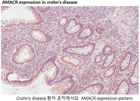 크론씨병 조직에서의 AMACR 발현