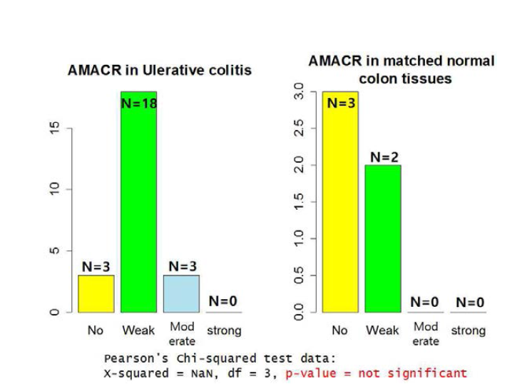 궤양성 대장염(ulcerative colitis) 장 점막세포에서의 AMACR 발현