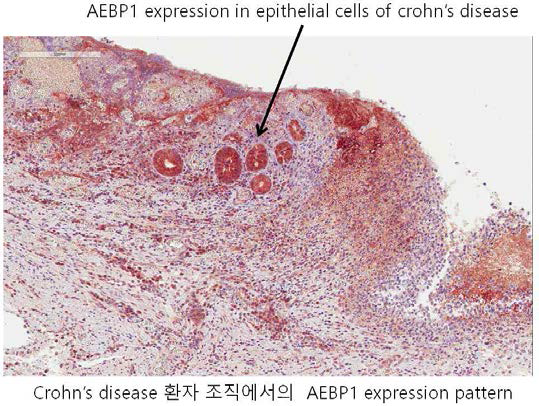 크론병 환자 조직에서의 AEBP1 발현 패턴