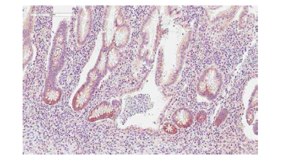 크론병 조직에서의 AMACR 발현 패턴