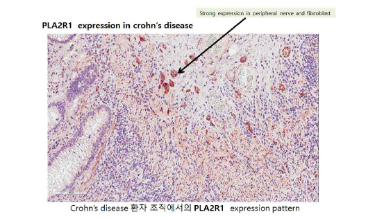 크론병 환자 조직에서의 PLA2R1의 발현 패턴