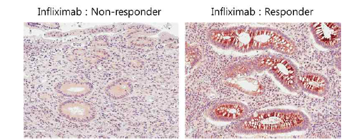 조직 면연화학염색법을 통한 인플릭시맙 치료에 대한 반응성에 따라 AEBP1 발현정도 확인