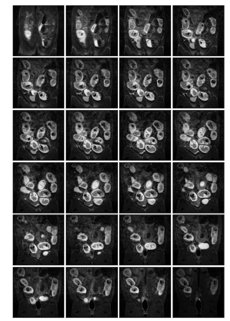 Normal control (rat 3, in-vivo) 태자의 16일 째 T2 weighted images
