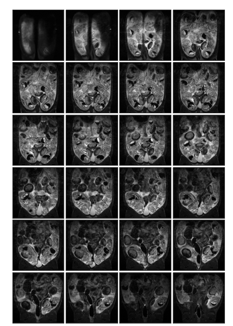 Normal control (rat 1, in-vivo) 태자의 20일 째 T2 weighted images