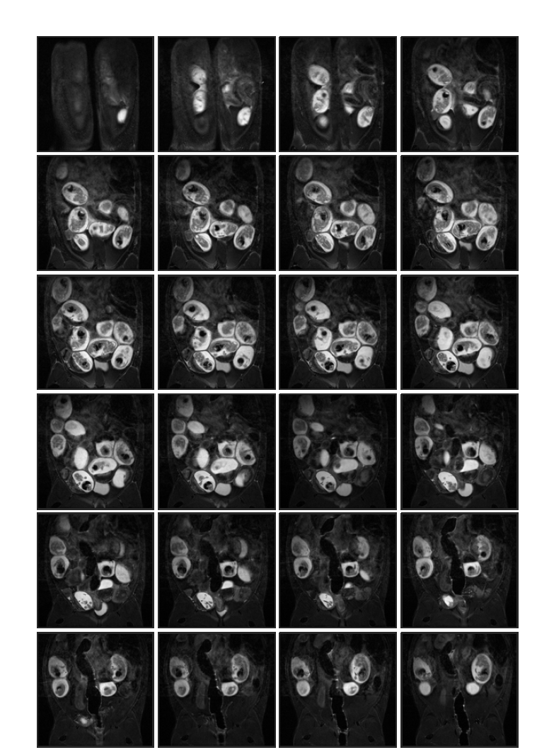 Cyclophosphamide 투여 (rat 4, in-vivo) 태자의 16일 째 T2 weighted images