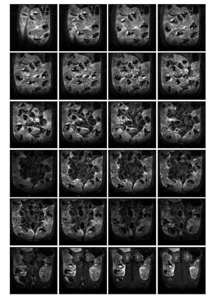 Cyclophosphamide 투여 (rat 2, in-vivo) 태자의 20일 째 T2 weighted images