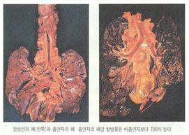 정상인의 폐(좌)와 흡연자의 폐(우) 비교