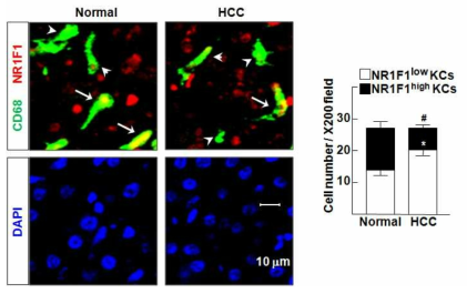 Normal 환자와 HCC 환자에서의 Kupffer cell NR1F1 발현양 비교