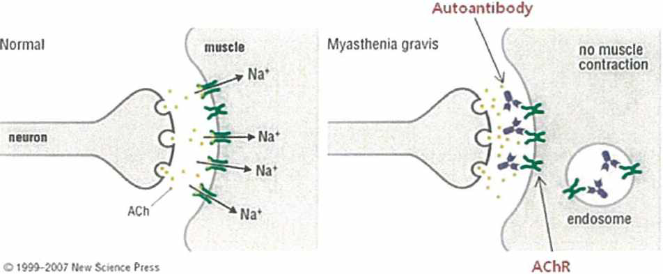 중중 근무력중의 발병 원인: 자가항체에 의한 아세틸콜린수용체의 기능상실