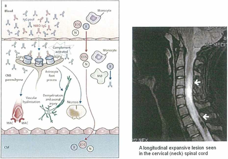 시신경 척수염(NM0 ) 의 발병 기전 및 환자의 척수 MRI 사진