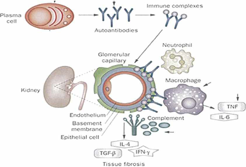 면역 복합제 침착에 의한 막성 신병증(membraneous nephropathy)의 발생 기작