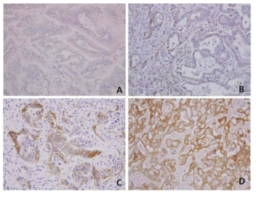 Differential expresssion pattern of L1CAM in intrahepatic cholangiocarcinoma. A, negative staining;B, weak statining; C, intermediate staining; D, strong staining