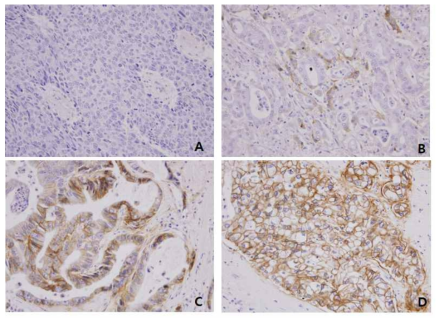 Expression pattern of EGFR in intrahepatic cholangiocarcinoma. A, negative staining; B, weak statining;C, intermediate staining; D, strong staining