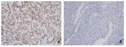 Expression pattern of β-catenin in intrahepatic cholangiocarcinoma. A, Membrane preserved; B, Membrane reduced with nuclear expression