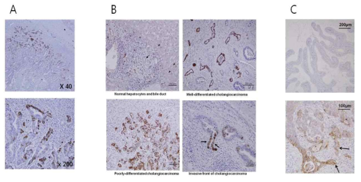 간외 담도암 (A), 간내 담도암 (B), 및 담낭암 (C)에서의 L1CAM 발현 양상