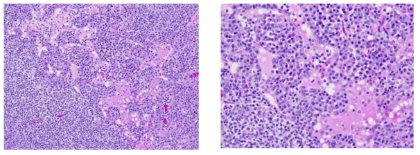 Thymic lymphoma가 관찰된 wild type 마우스에서 관찰된 비장 정상구소 소실 (cortex & medulla), lymphocytic hyperplasia