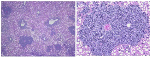 Wild type 마우스에서 관찰된 간 전이 (Lipidosis, peri-vascular metastasis)