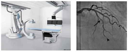 (왼쪽) C-arm CT (이미지 출처 Siemens AG). (오른쪽) 관상동맥 조영영상