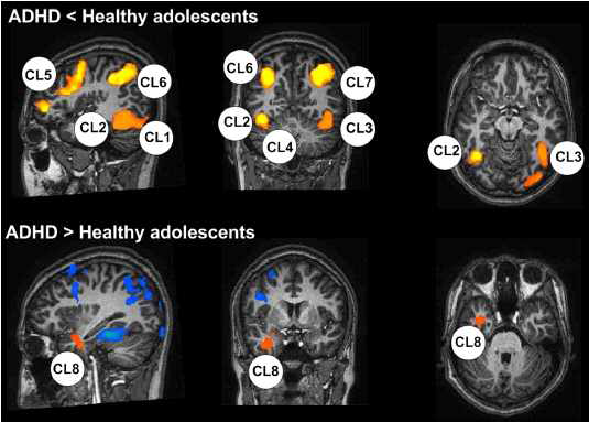 Areas of different brain activation between the ADHD group and the healthy control group in reponse to the WCST.