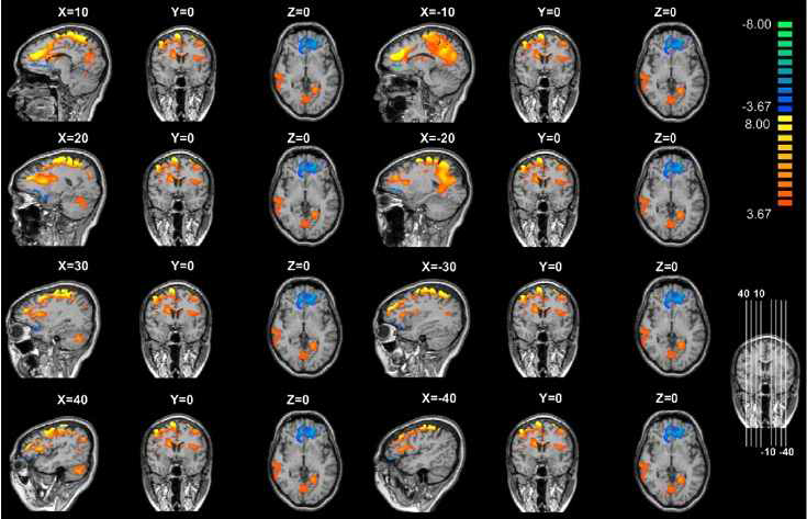 Brain connectivity in subjectswith alcohol dependence.