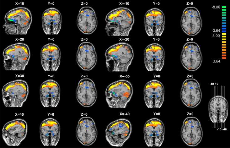 Brain connectivity in subjectswith internet gaming disorder.