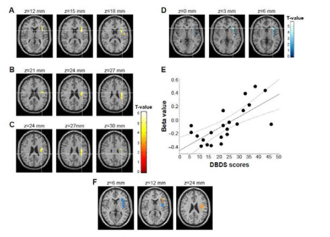 Default network in depressive adolescents with disruptive behaviors