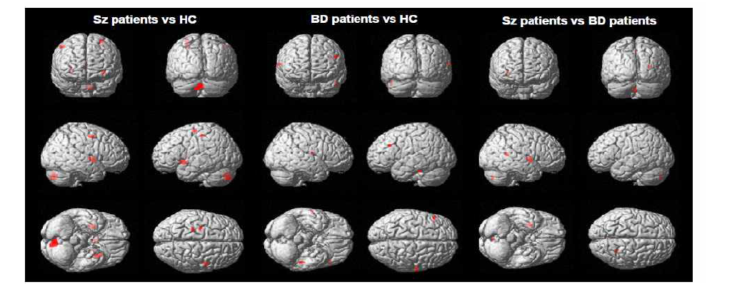 Regions with significant gray matter differences in group comparisons