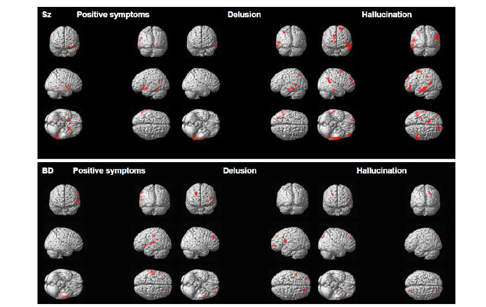 Correlations between symptoms and gray matter volume in schizophrenia patients with bipolar disorder patients