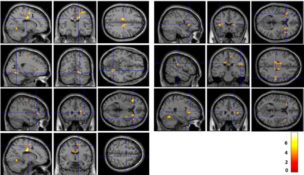 Comparison of brain FC from the precentral gyrus to other regions between sport dancers and control subjects.