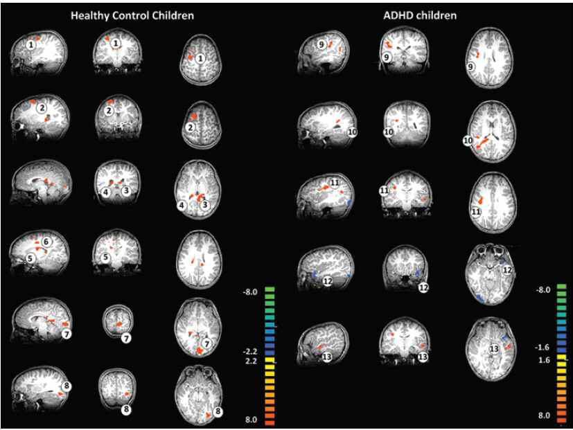 Changes in brain connectivity after the 4 weeks of horse riding training