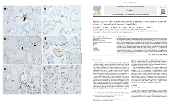대표적 태반손상 병변에서의 C4d 침착: a,b: 특발성태반염, c,d: 거대세포바이러스성태 반염, e,f: 태반경색 (좌)와 발표 논문 (우).