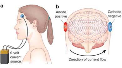 　tDCS